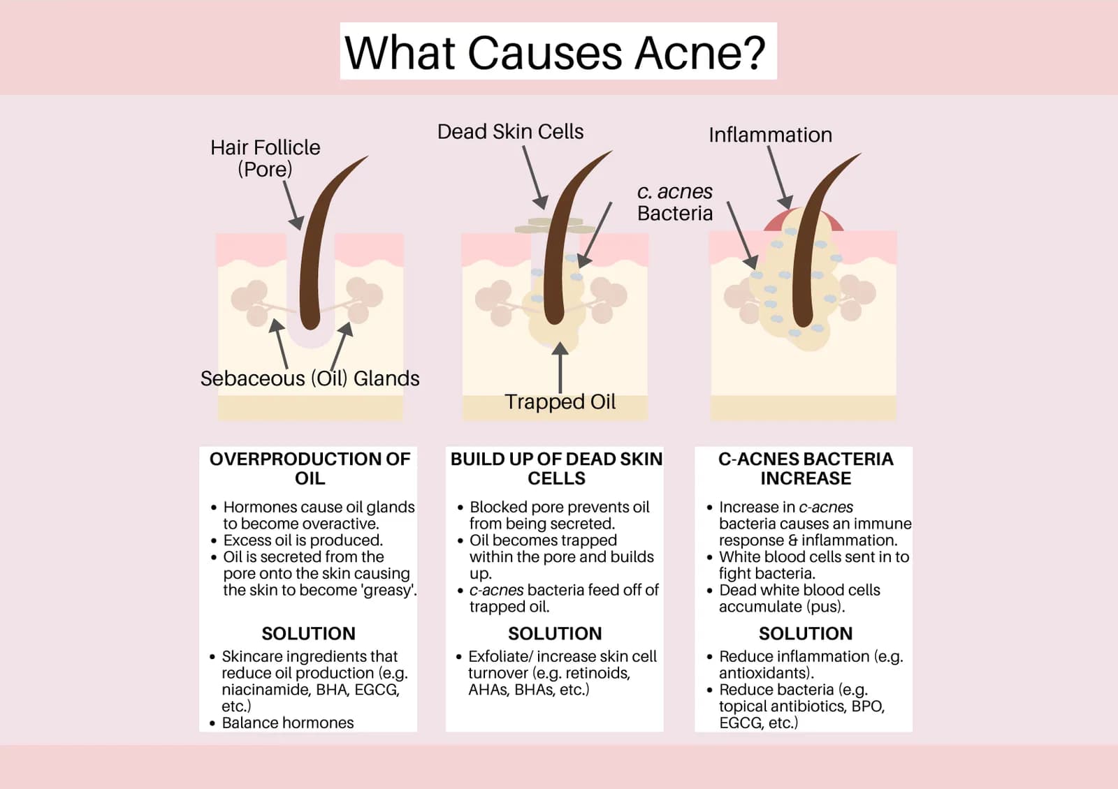 The Science of Acne: Real Causes and How to Treat It